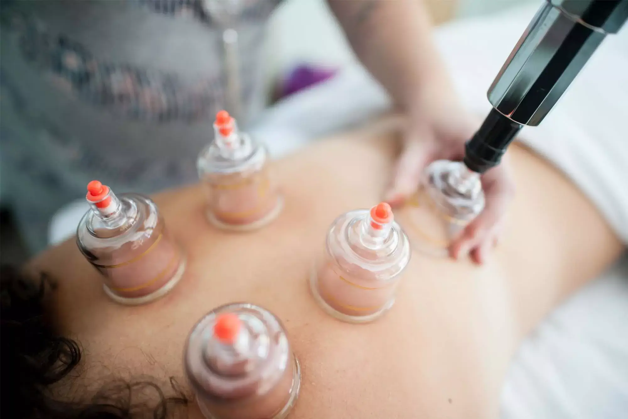 NHRC-myofascial-cupping